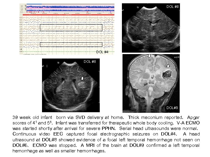 DOL #6 DOL#8 DOL #4 DOL #8 DOL#9 39 week old infant born via