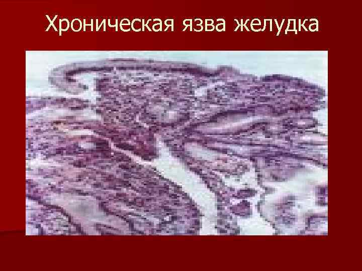 Хроническая язва желудка 