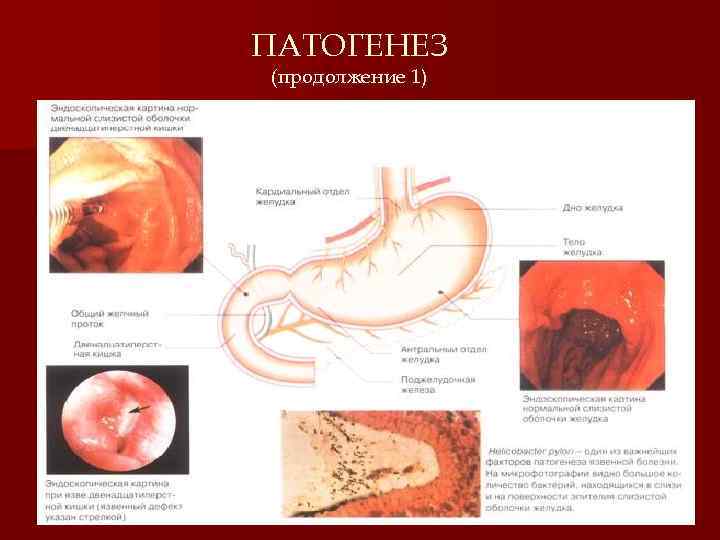ПАТОГЕНЕЗ (продолжение 1) 5 