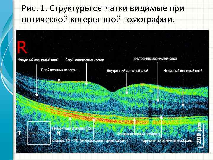 Рис. 1. Структуры сетчатки видимые при оптической когерентной томографии. 