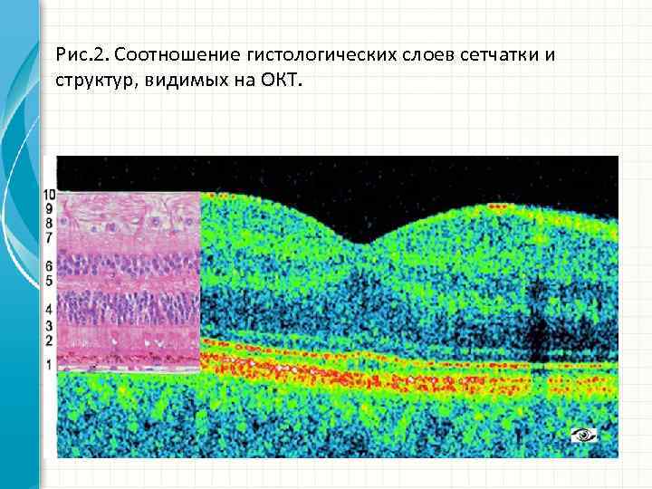 Рис. 2. Соотношение гистологических слоев сетчатки и структур, видимых на ОКТ. 