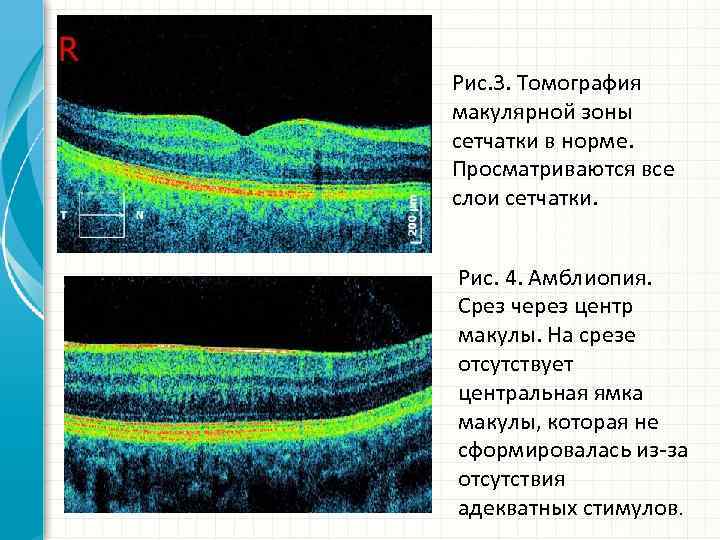 Рис. 3. Томография макулярной зоны сетчатки в норме. Просматриваются все слои сетчатки. Рис. 4.