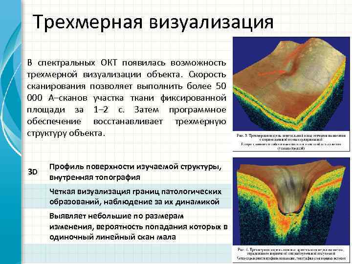 Трехмерная визуализация В спектральных ОКТ появилась возможность трехмерной визуализации объекта. Скорость сканирования позволяет выполнить