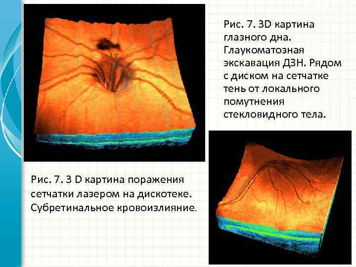 Рис. 7. 3 D картина глазного дна. Глаукоматозная экскавация ДЗН. Рядом с диском на