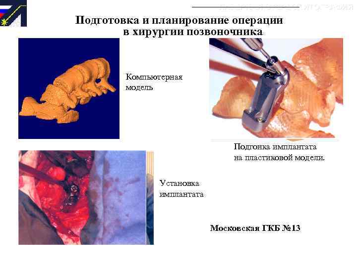 ЛАЗЕРНАЯ СТЕРЕОЛИТОГРАФИЯ Подготовка и планирование операции в хирургии позвоночника Компьютерная модель Пластиковая модель Подгонка
