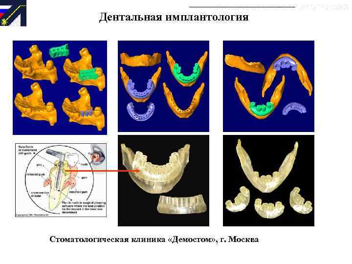 ЛАЗЕРНАЯ СТЕРЕОЛИТОГРАФИЯ Дентальная имплантология Стоматологическая клиника «Демостом» , г. Москва 