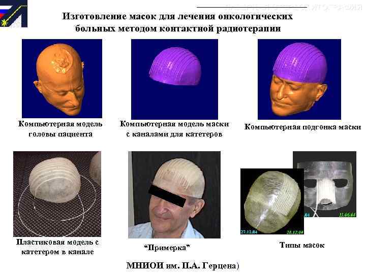 ЛАЗЕРНАЯ СТЕРЕОЛИТОГРАФИЯ Изготовление масок для лечения онкологических больных методом контактной радиотерапии Компьютерная модель головы