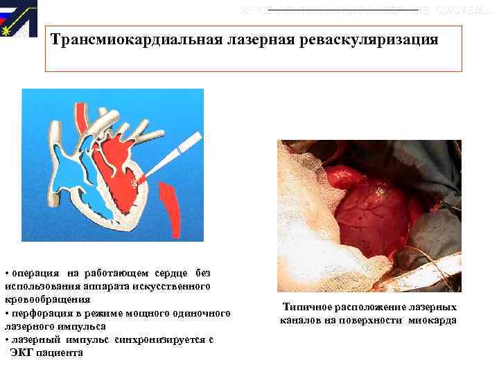 ИНТЕЛЛЕКТУАЛЬНЫЕ ЛАЗЕРНЫЕ СИСТЕМЫ Трансмиокардиальная лазерная реваскуляризация • операция на работающем сердце без использования аппарата