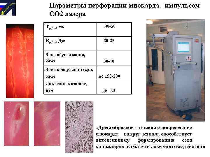 Параметры перфорации миокарда импульсом СО 2 лазера Tpulse, мс 30 -50 Epulse, Дж 20