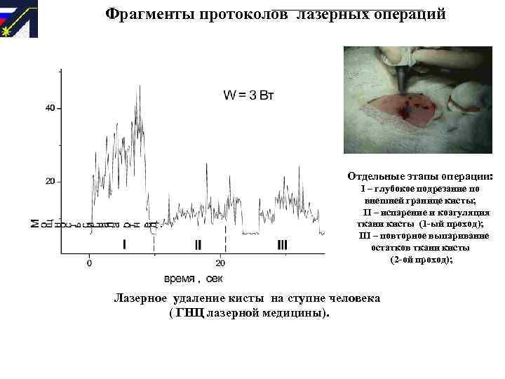 Фрагменты протоколов лазерных операций Отдельные этапы операции: I – глубокое подрезание по внешней границе