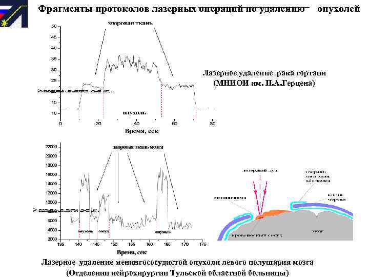 Фрагменты протоколов лазерных операций по удалению опухолей Лазерное удаление рака гортани (МНИОИ им. П.