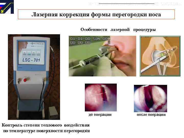 ИНТЕЛЛЕКТУАЛЬНЫЕ ЛАЗЕРНЫЕ СИСТЕМЫ Лазерная коррекция формы перегородки носа Особенности лазерной процедуры до операции Контроль