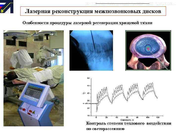 ИНТЕЛЛЕКТУАЛЬНЫЕ ЛАЗЕРНЫЕ СИСТЕМЫ Лазерная реконструкция межпозвонковых дисков Особенности процедуры лазерной регенерации хрящевой ткани Контроль