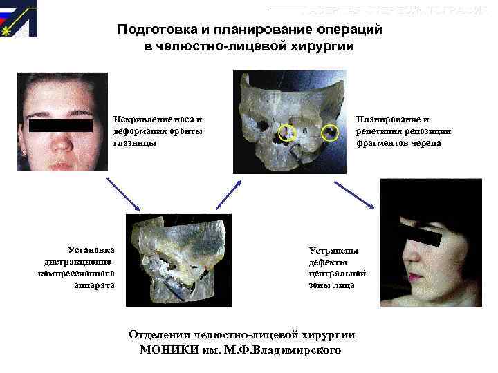 ЛАЗЕРНАЯ СТЕРЕОЛИТОГРАФИЯ Подготовка и планирование операций в челюстно-лицевой хирургии Искривление носа и деформация орбиты