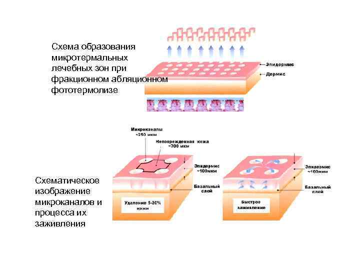 Схема образования микротермальных лечебных зон при фракционном абляционном фототермолизе Схематическое изображение микроканалов и процесса