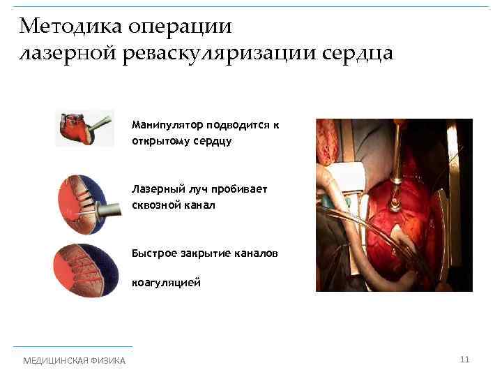 Методика операции лазерной реваскуляризации сердца Манипулятор подводится к открытому сердцу Лазерный луч пробивает сквозной