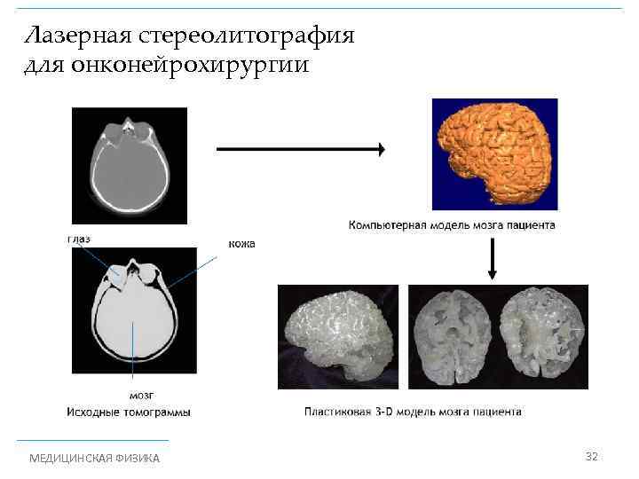 Лазерная стереолитография для онконейрохирургии МЕДИЦИНСКАЯ ФИЗИКА 32 