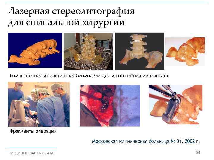 Лазерная стереолитография для спинальной хирургии Компьютерная и пластиковая биомодели для изготовления имплантата Фрагменты операции