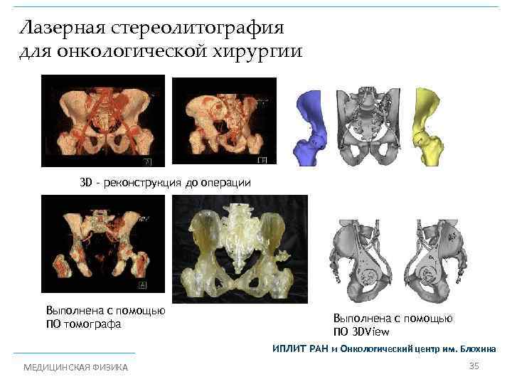 Лазерная стереолитография для онкологической хирургии 3 D – реконструкция до операции Выполнена с помощью