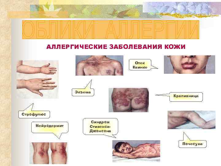 АЛЛЕРГИЧЕСКИЕ ЗАБОЛЕВАНИЯ КОЖИ Отек Квинке Экзема Крапивница Строфулюс Нейродермит Синдром Стивенса. Джонсона Почесуха 