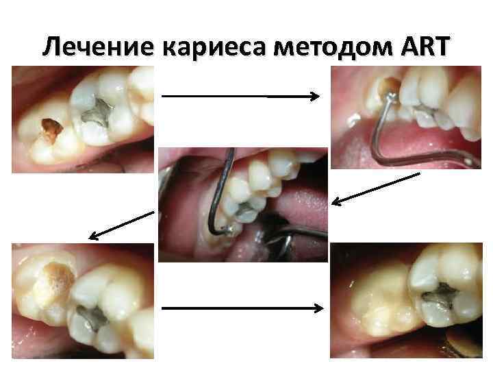 Лечение кариеса методом ART 