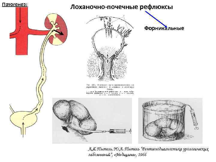 Патогенез: Лоханочно-почечные рефлюксы Форникальные А. Я. Пытель, Ю. А. Пытель “Рентгенодиагностика урологических заболеваний”, «Медицина»