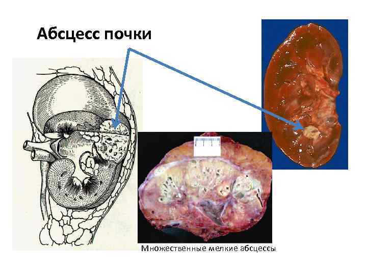 Абсцесс почки Множественные мелкие абсцессы 