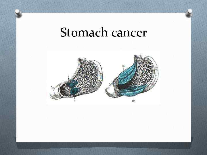 Stomach cancer 
