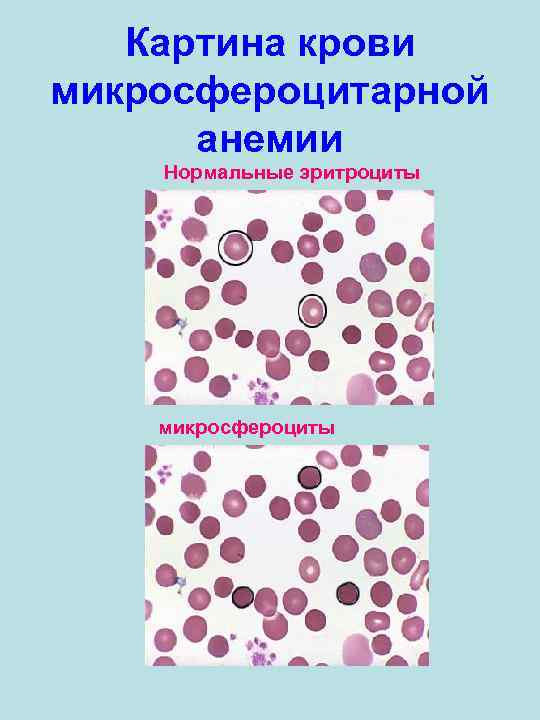 Картина крови микросфероцитарной анемии Нормальные эритроциты микросфероциты 