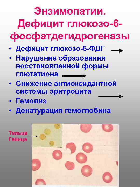 Энзимопатии. Дефицит глюкозо-6 фосфатдегидрогеназы • Дефицит глюкозо-6 -ФДГ • Нарушение образования восстановленной формы глютатиона
