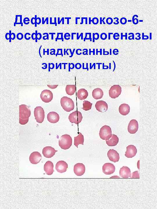 Дефицит глюкозо-6 фосфатдегидрогеназы (надкусанные эритроциты) 