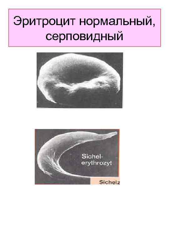 Эритроцит нормальный, серповидный 