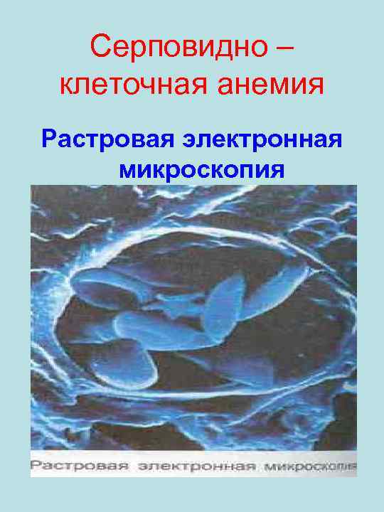Серповидно – клеточная анемия Растровая электронная микроскопия 
