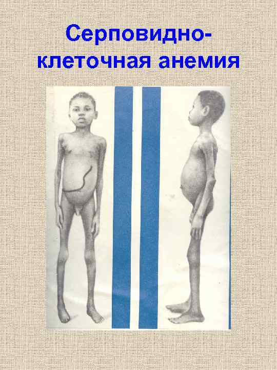 Серповидноклеточная анемия 