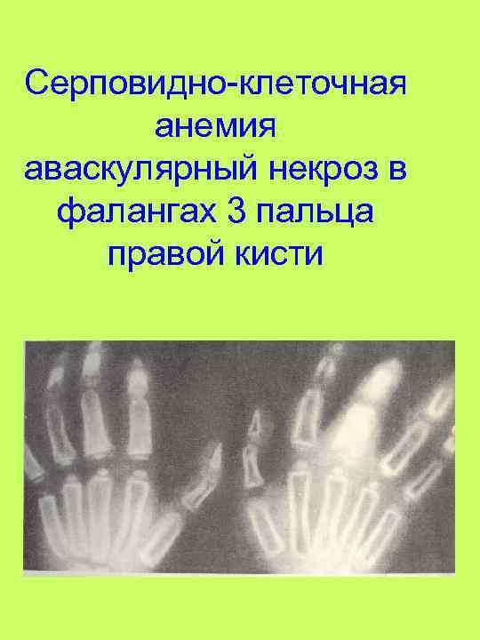 Серповидно-клеточная анемия аваскулярный некроз в фалангах 3 пальца правой кисти 