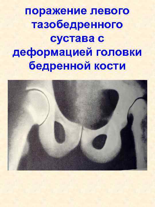 поражение левого тазобедренного сустава с деформацией головки бедренной кости 