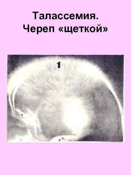 Талассемия. Череп «щеткой» 