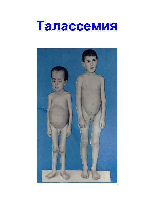 Талассемия 