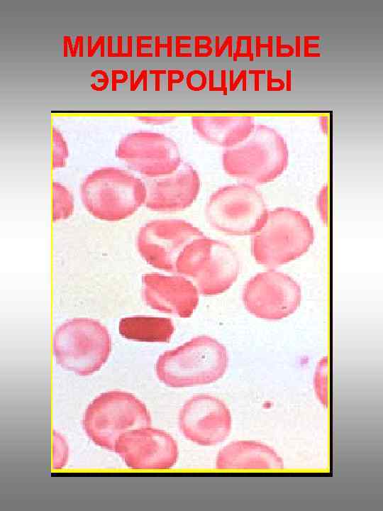 МИШЕНЕВИДНЫЕ ЭРИТРОЦИТЫ 