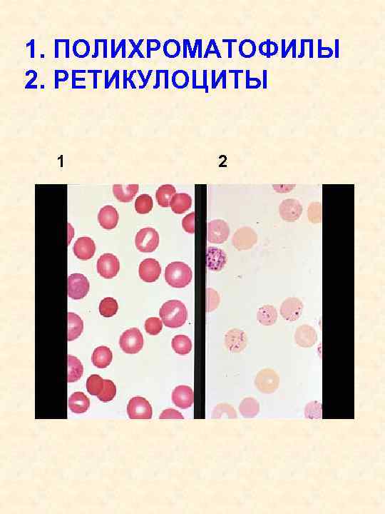 1. ПОЛИХРОМАТОФИЛЫ 2. РЕТИКУЛОЦИТЫ 1 2 