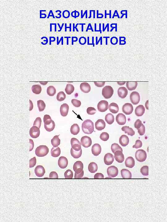 БАЗОФИЛЬНАЯ ПУНКТАЦИЯ ЭРИТРОЦИТОВ 