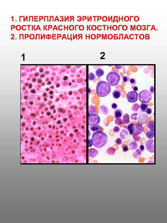 1. ГИПЕРПЛАЗИЯ ЭРИТРОИДНОГО РОСТКА КРАСНОГО КОСТНОГО МОЗГА. 2. ПРОЛИФЕРАЦИЯ НОРМОБЛАСТОВ 1 2 
