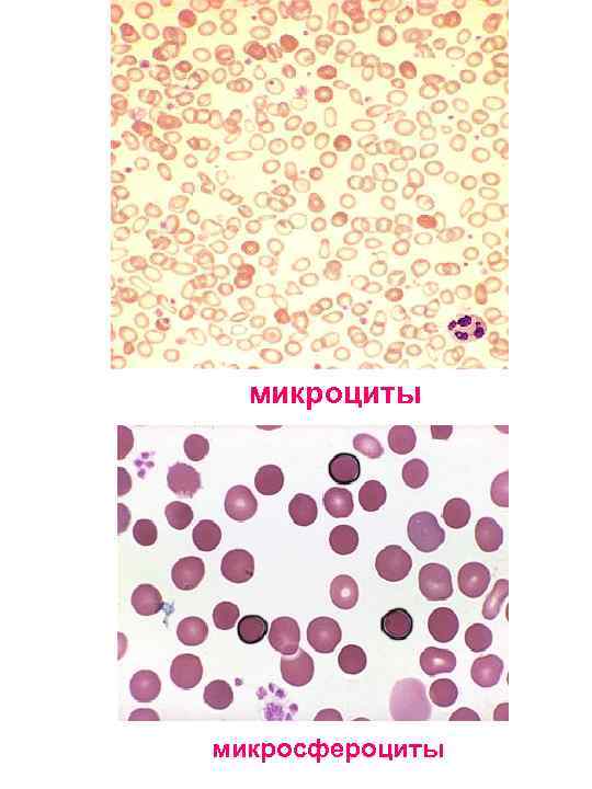 микроциты микросфероциты 