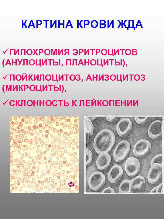 КАРТИНА КРОВИ ЖДА üГИПОХРОМИЯ ЭРИТРОЦИТОВ (АНУЛОЦИТЫ, ПЛАНОЦИТЫ), üПОЙКИЛОЦИТОЗ, АНИЗОЦИТОЗ (МИКРОЦИТЫ), üСКЛОННОСТЬ К ЛЕЙКОПЕНИИ 