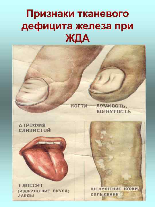 Признаки тканевого дефицита железа при ЖДА 
