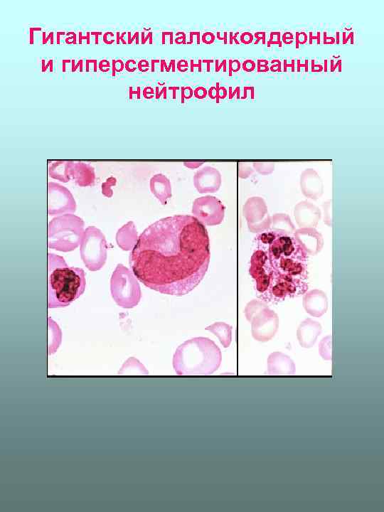 Гигантский палочкоядерный и гиперсегментированный нейтрофил 