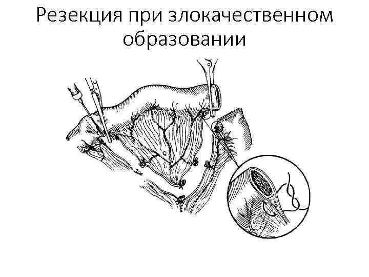 Резекция при злокачественном образовании 