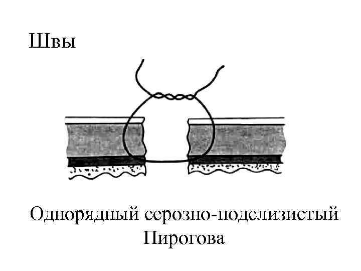 Швы Однорядный серозно-подслизистый Пирогова 