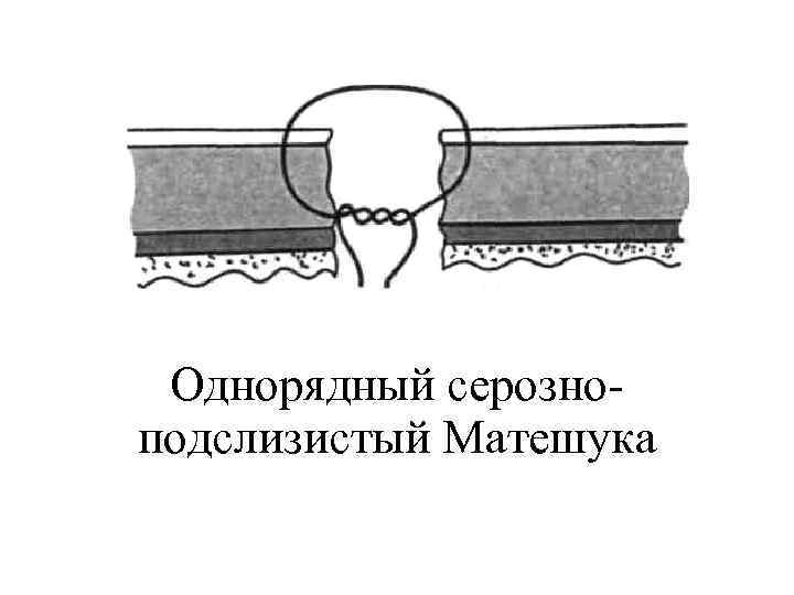 Однорядный серозноподслизистый Матешука 