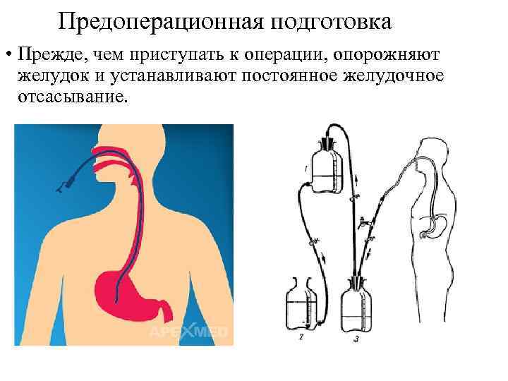 Предоперационная подготовка • Прежде, чем приступать к операции, опорожняют желудок и устанавливают постоянное желудочное